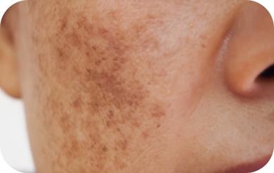 Usuwanie przebarwień na twarzy Wrocław