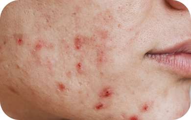 Usuwanie trądziku wrocław