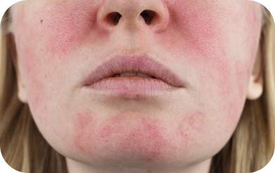 zabiegi na skórę naczynkową i zaczerwienioną Wrocław